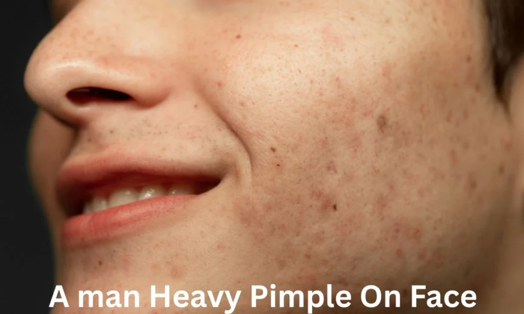 A Man Heavy Pimple On Face 1024x614