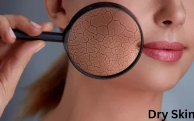 Dry Skin