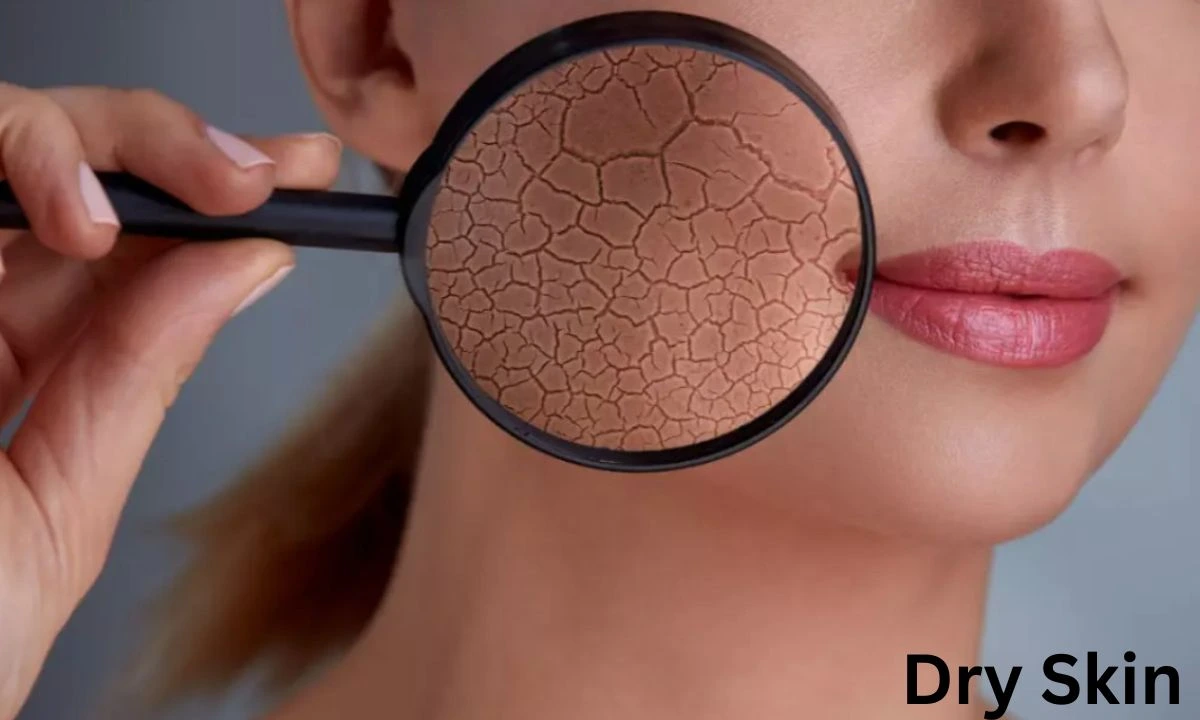 Dry Skin
