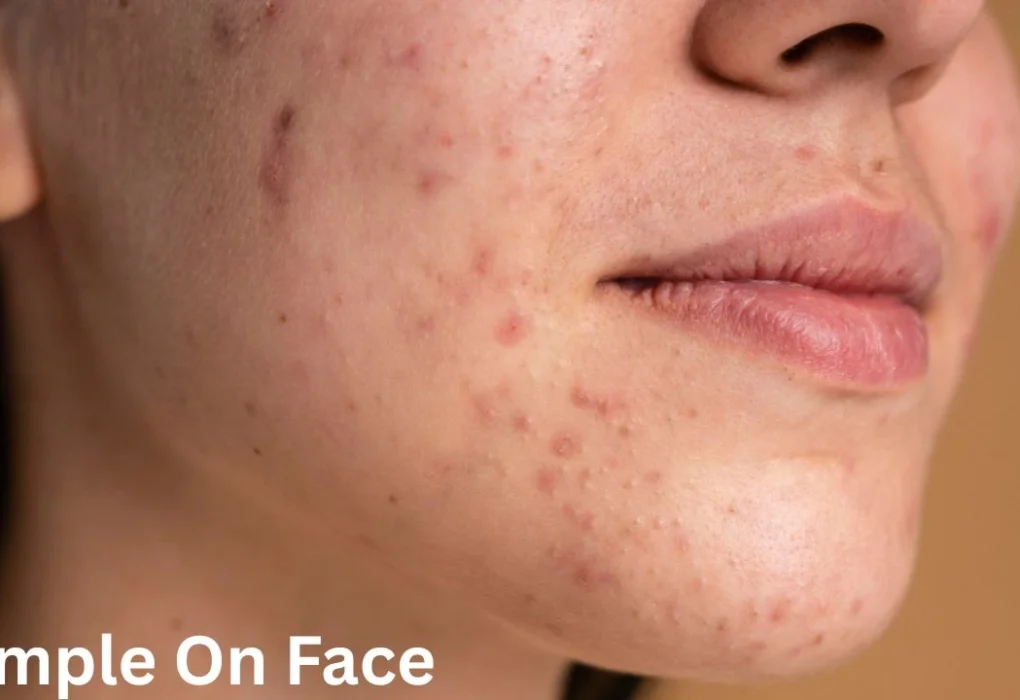 Pimple ( A Girl Heavy Pimple On Face )