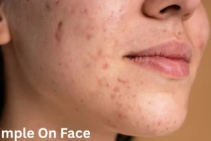 Pimple ( A Girl Heavy Pimple On Face )