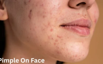 Pimple On Face