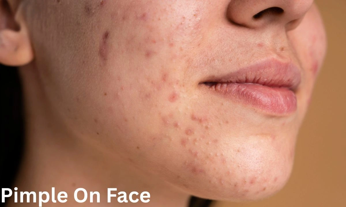 Pimple On Face